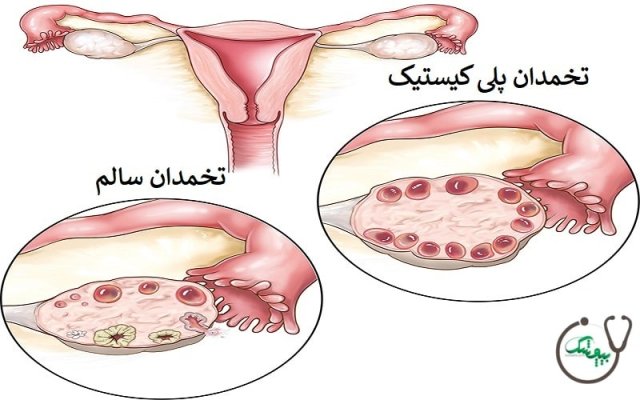 سندرم تخمدان پلی کیستیک یا تنبلی تخمدان