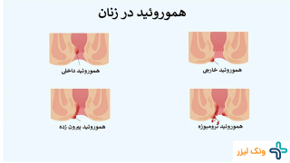 علت هموروئید در زنان