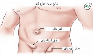 شایع ترین انواع فتق