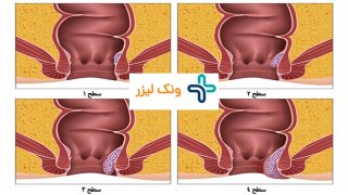 4 درجه بندی هموروئید داخلی