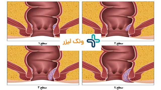 4 درجه بندی هموروئید داخلی