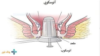 آنوسکوپی یا معاینه مقعدی