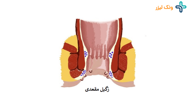 زگیل مقعدی در زنان و مردان