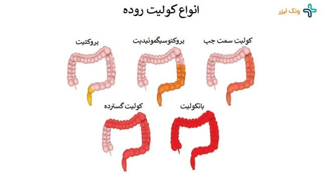 انواع کولیت روده و روش های درمان آن