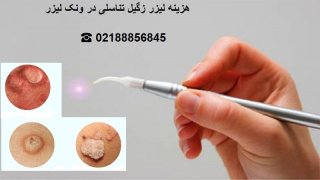 هزینه لیزر زگیل تناسلی