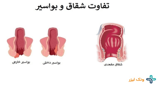 چگونه شقاق و بواسیر را از یکدیگر تشخیص دهیم؟