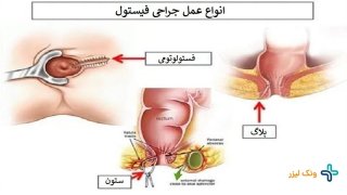 مراقبت های لازم برای بعد از عمل فیستول