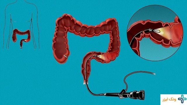 تست سیگموئیدوسکوپی چیست + مراقبت های بعد از آن