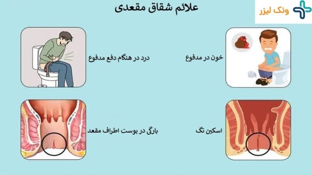 همه چیز در مورد شقاق مقعدی