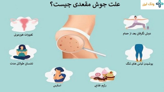 علت جوش مقعدی چیست و چگونه درمان می شود؟