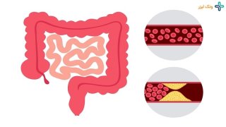 بیماری ایسکمی روده چیست؟ {بررسی کامل این بیماری}