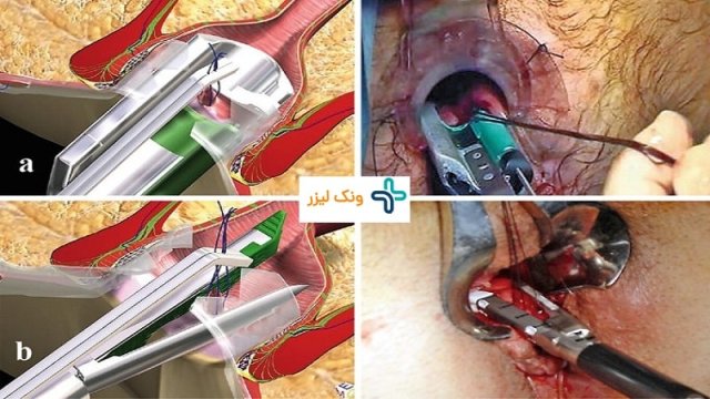 جراحی vaaft برای درمان فیستول مقعدی چیست