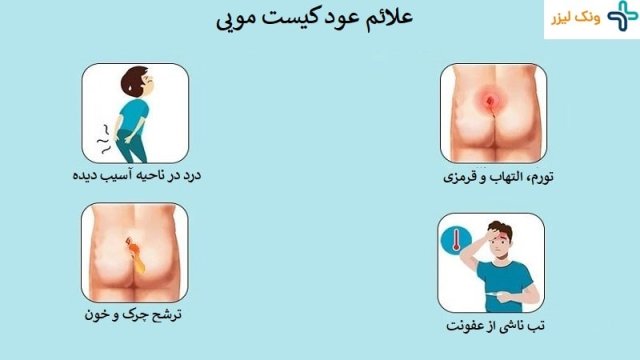 علائم و علل عود کیست مویی بعد از عمل