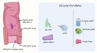 چه روشهایی برای درمان هموروئید زنان وجود دارد؟