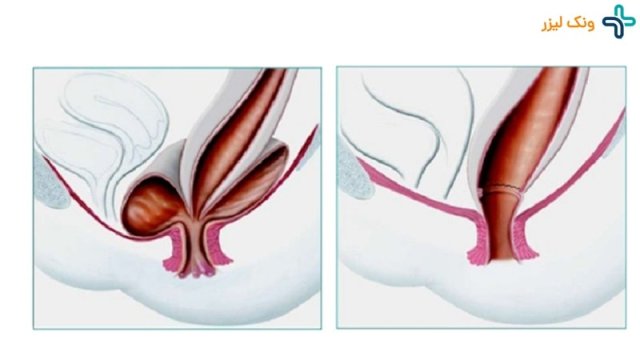 سندرم دفع سخت مدفوع چیست و چه علائمی دارد؟