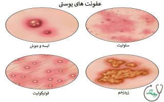 علت عفونت پوستی چیست؟