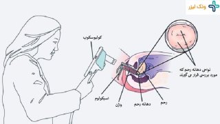 آزمایش کولپوسکوپی چیست و چگونه انجام می شود؟