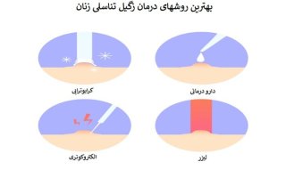 بررسی روشهای درمان زگیل تناسلی زنان و میزان اثرگذاری آنها